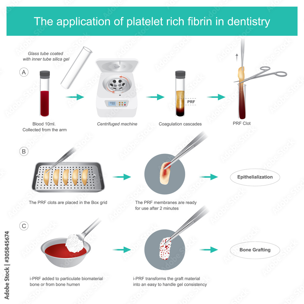 tooth removal