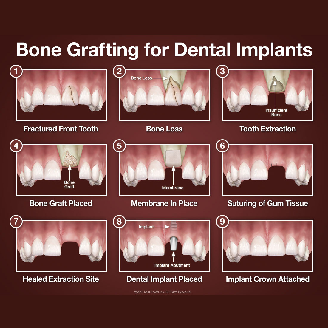 Bone Grafting