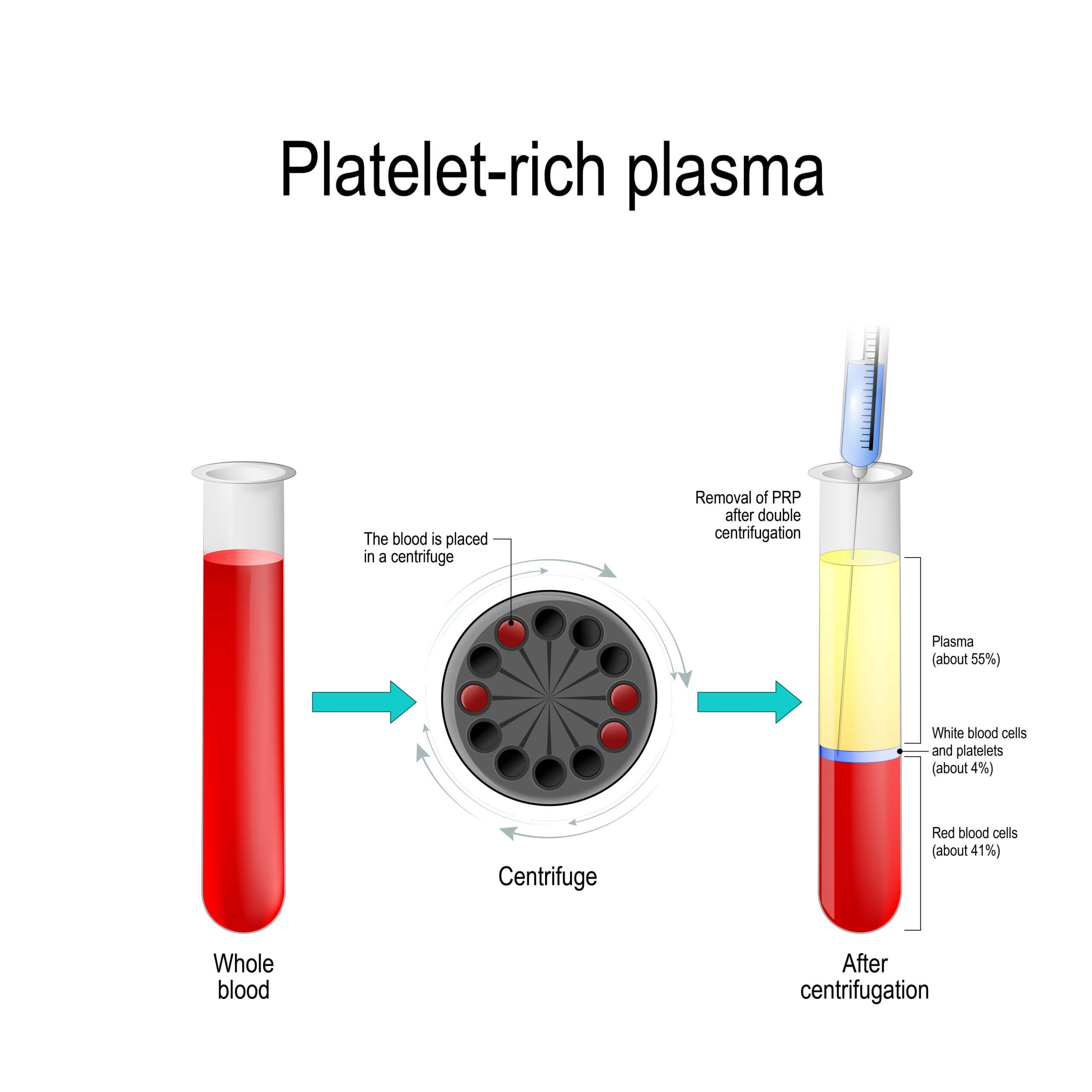 Extractions/Tooth Removal (PRF)